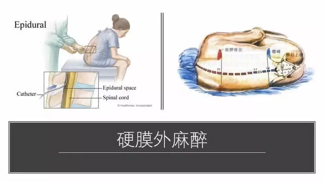 无痛分娩 第1张